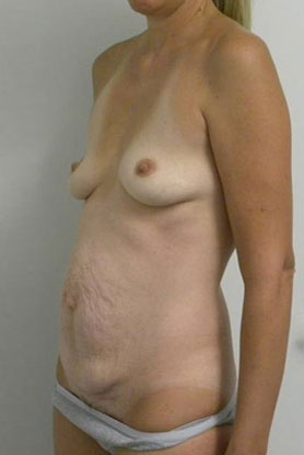 Mommy Makeover Case 3822 Before Photo Mommy Makeover