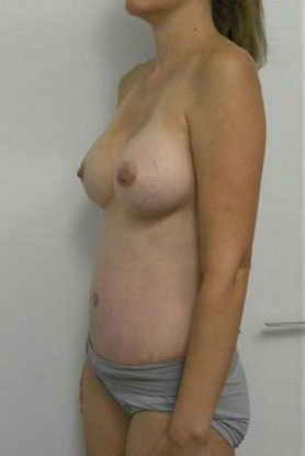 Mommy Makeover Case 3822 After Photo Mommy Makeover