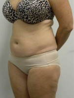 Tummy tuck (Abdominoplasty)