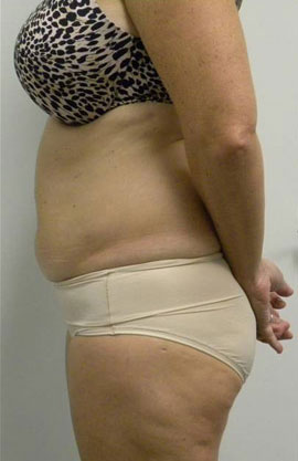 Tummy tuck (Abdominoplasty)