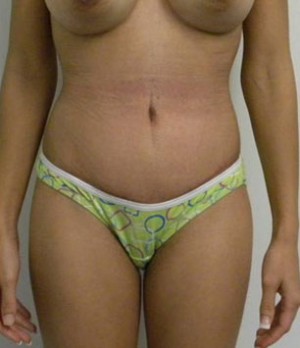 Tummy tuck (Abdominoplasty) Case 3997 After Photo Tummy tuck (Abdominoplasty)