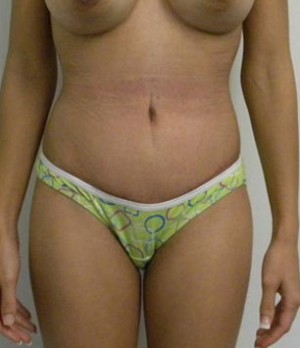 Tummy tuck (Abdominoplasty)