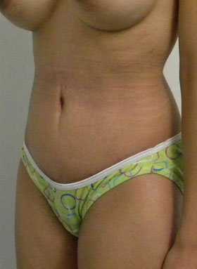 Tummy tuck (Abdominoplasty)