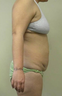 Tummy tuck (Abdominoplasty)