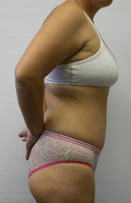 Tummy tuck (Abdominoplasty)