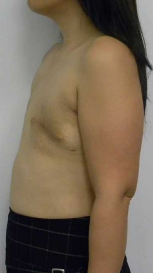 Breast Reconstruction Case 0286 Before Photo Breast Reconstruction