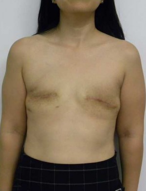 Breast Reconstruction Case 0286 Before Photo Breast Reconstruction