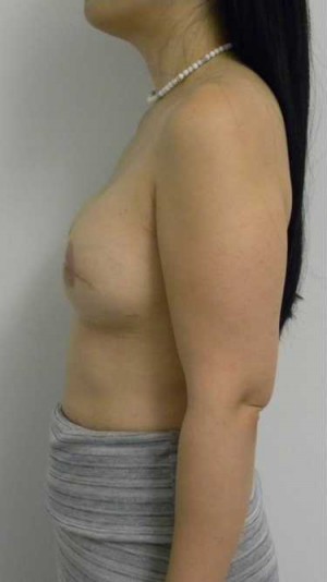Breast Reconstruction Case 0286 After Photo Breast Reconstruction