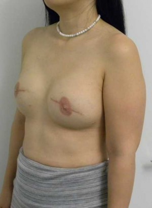 Breast Reconstruction Case 0286 After Photo Breast Reconstruction