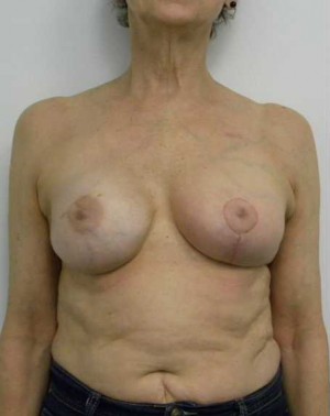 Breast Reconstruction Case 3511 After Photo Breast Reconstruction