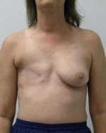 Breast Reconstruction