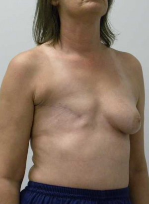 Breast Reconstruction Case 3518 Before Photo Breast Reconstruction
