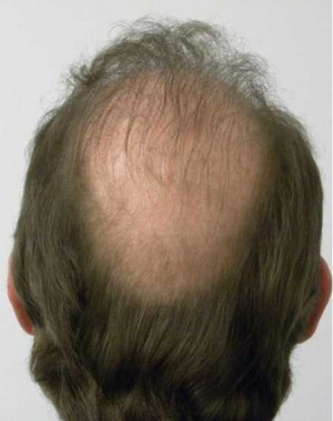 Hair Transplant Case 3538 After Photo Hair Transplant