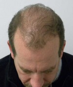 Hair Transplant