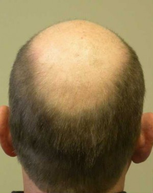 Hair Transplant Case 3538 Before Photo Hair Transplant