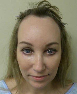 Hair Transplant Case 3545 Before Photo Hair Transplant