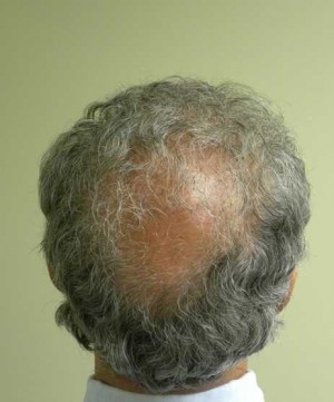 Hair Transplant Case 3548 After Photo Hair Transplant