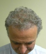 Hair Transplant