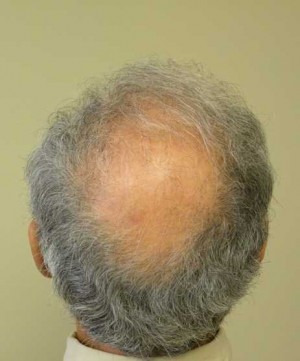 Hair Transplant Case 3548 Before Photo Hair Transplant