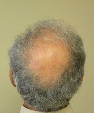 Hair Transplant