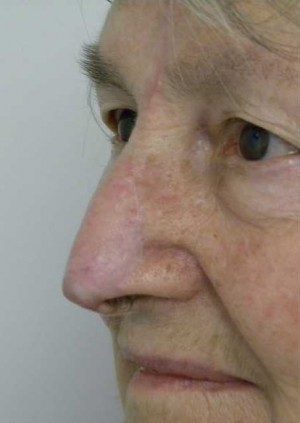 Skin Cancer Reconstruction