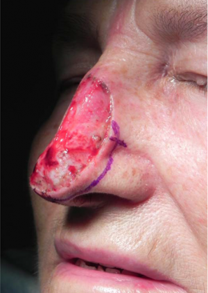 Skin Cancer Reconstruction