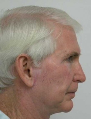 Skin Cancer Reconstruction Case 3571 After Photo Skin Cancer Reconstruction