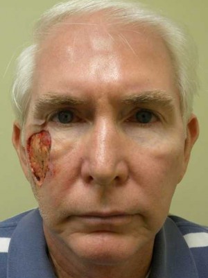 Skin Cancer Reconstruction Case 3571 Before Photo Skin Cancer Reconstruction