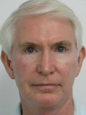 Skin Cancer Reconstruction Case 3571 After Photo Skin Cancer Reconstruction