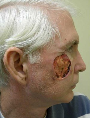 Skin Cancer Reconstruction Case 3571 Before Photo Skin Cancer Reconstruction