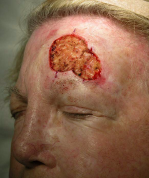 Skin Cancer Reconstruction Case 3579 Before Photo Skin Cancer Reconstruction
