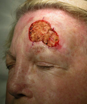 Skin Cancer Reconstruction