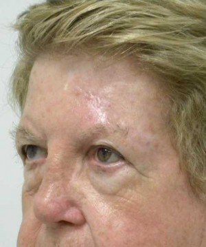 Skin Cancer Reconstruction Case 3579 After Photo Skin Cancer Reconstruction