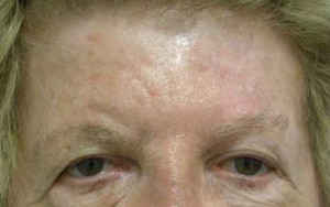 Skin Cancer Reconstruction Case 3579 After Photo Skin Cancer Reconstruction