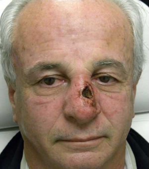 Skin Cancer Reconstruction Case 3584 Before Photo Skin Cancer Reconstruction
