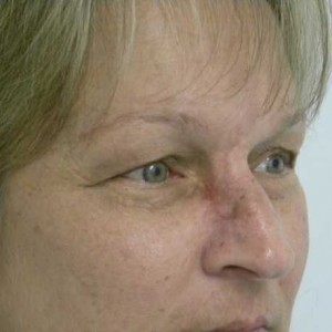 Skin Cancer Reconstruction Case 3587 After Photo Skin Cancer Reconstruction
