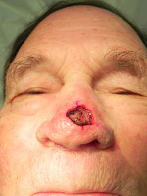 Skin Cancer Reconstruction Case 3590 Before Photo Skin Cancer Reconstruction