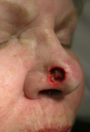 Skin Cancer Reconstruction Case 3593 Before Photo Skin Cancer Reconstruction
