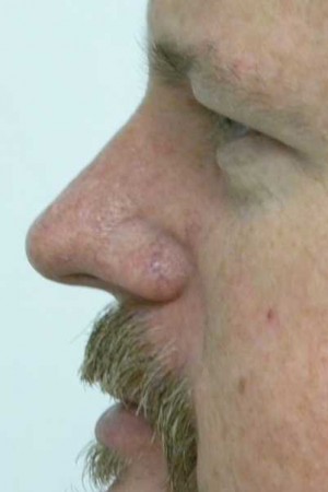 Skin Cancer Reconstruction Case 3596 After Photo Skin Cancer Reconstruction