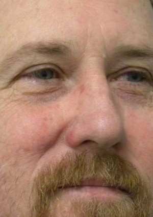 Skin Cancer Reconstruction Case 3602 After Photo Skin Cancer Reconstruction