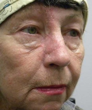 Skin Cancer Reconstruction Case 3605 After Photo Skin Cancer Reconstruction