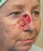 Skin Cancer Reconstruction