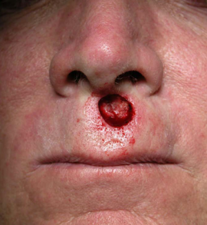 Skin Cancer Reconstruction Case 3608 Before Photo Skin Cancer Reconstruction