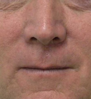 Skin Cancer Reconstruction Case 3608 After Photo Skin Cancer Reconstruction
