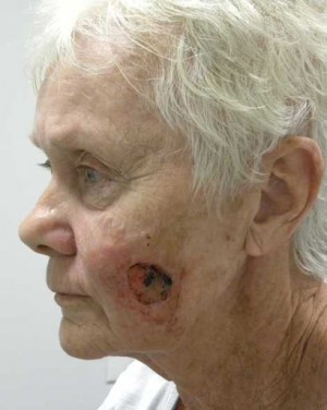 Skin Cancer Reconstruction Case 3611 Before Photo Skin Cancer Reconstruction