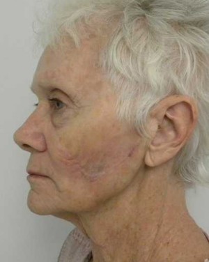 Skin Cancer Reconstruction Case 3611 After Photo Skin Cancer Reconstruction