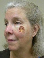 Skin Cancer Reconstruction