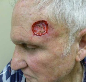 Skin Cancer Reconstruction Case 3623 Before Photo Skin Cancer Reconstruction