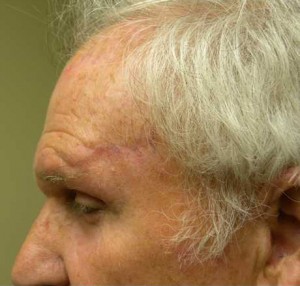 Skin Cancer Reconstruction Case 3623 After Photo Skin Cancer Reconstruction