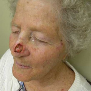 Skin Cancer Reconstruction Case 3629 Before Photo Skin Cancer Reconstruction